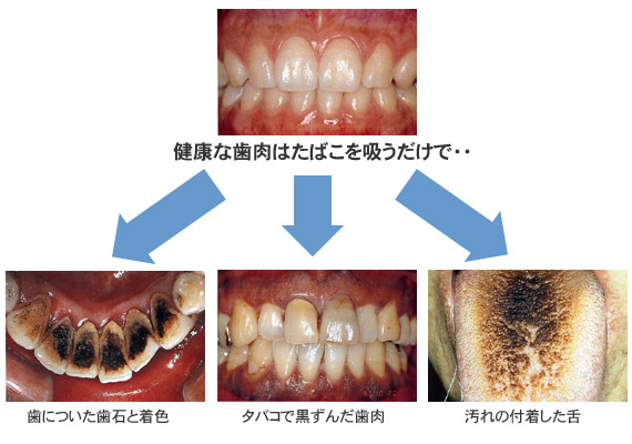 健康な歯肉はたばこを吸うだけで・・・/歯に付いた歯石と着色・タバコで黒ずんだ歯肉・汚れの付着した舌